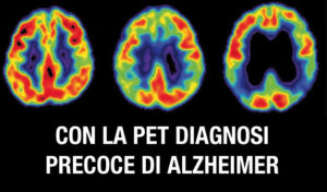 Con La Pet Diagnosi Precoce Di Alzheimer Salutepi