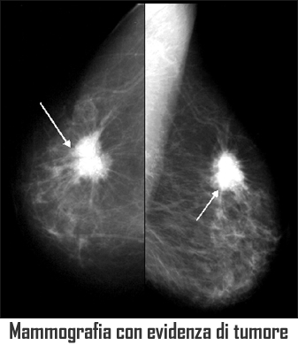 tumore della mammella tumore del seno