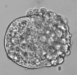 tumor sfera glioblastoma