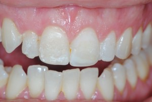 fascette dentali fascette estetiche veneers